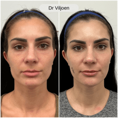 Dermal Filler 4