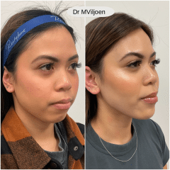 Dermal Filler 1