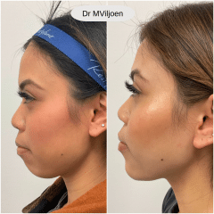Dermal Filler 1