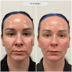 Dermal Filler 2