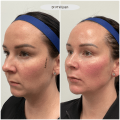 Dermal Filler 2