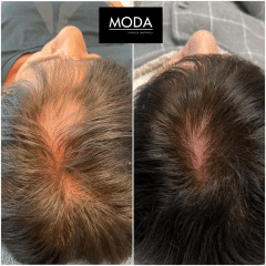 JetPeel/Hair Regrowth Case 1