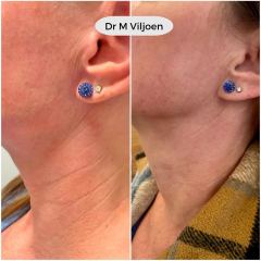 radiesse case 1